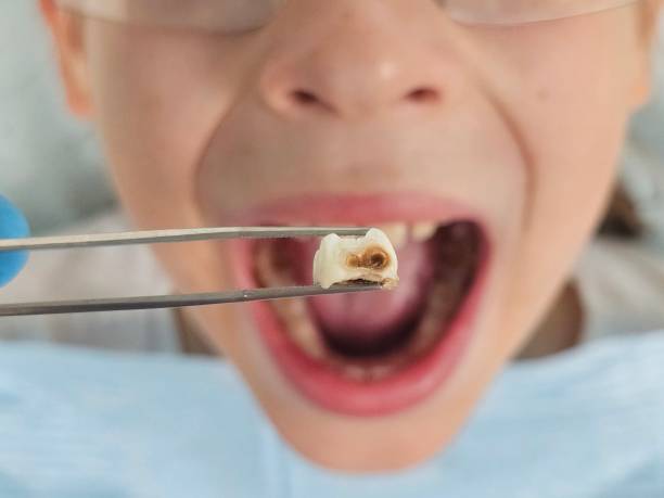 Best Knocked-Out Tooth (Avulsed Tooth) Treatment in Pineville, KY